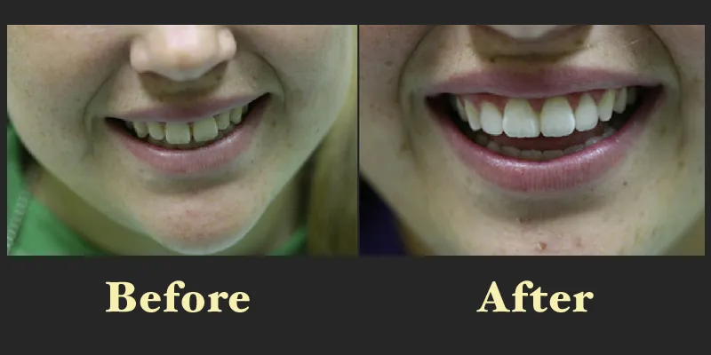 Smile Gallery | Before & After Dentistry